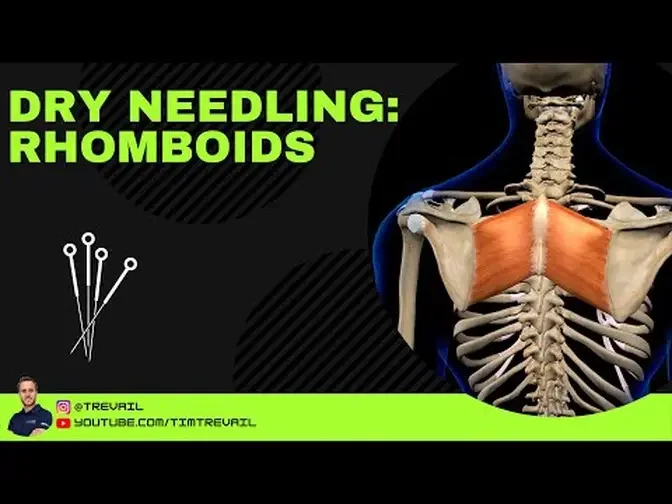 Dry Needling: Rhomboids