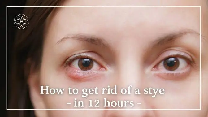 How to get rid of a stye in 12 hours