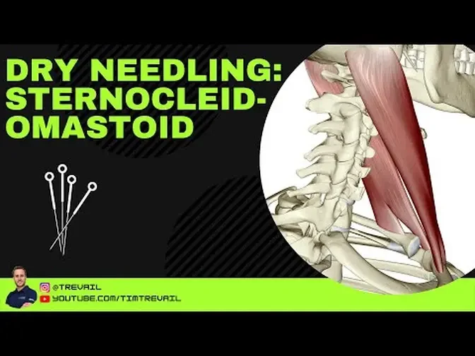 Dry Needling: Sternocleidomastoid