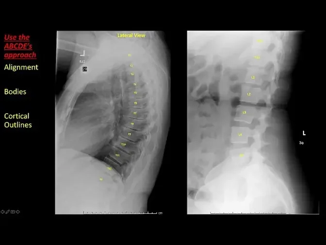 Introduction to Spine Radiographs