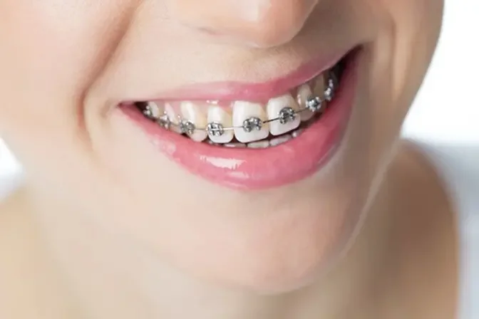 Beyond Aesthetics: The Health Benefits of Dental Braces in Dubai