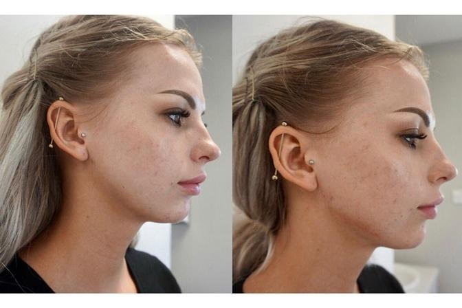 Enhancing Facial Features with Jawline Filler and Cheek Filler