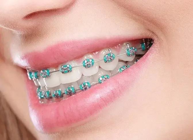 Unlocking the Potential of Orthodontics: Dubai's Approach to Dental Health