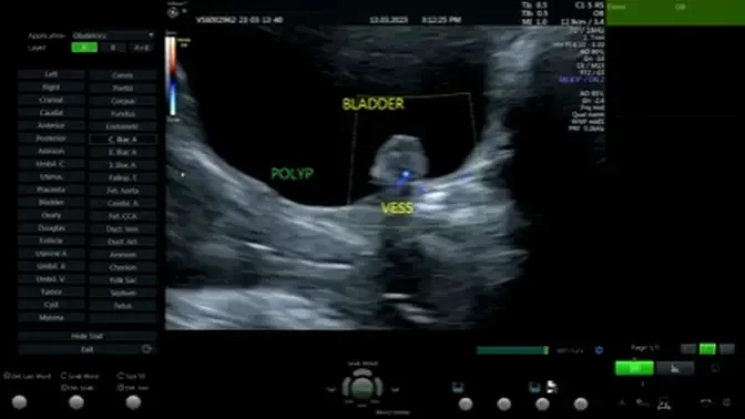 Polype Bladder Ultrasound