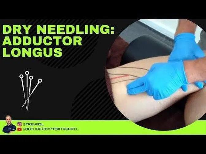 Dry Needling: Adductor Longus