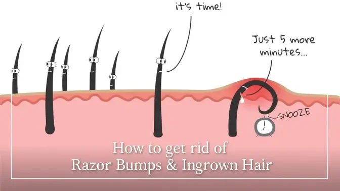 How to get rid of Razor Bumps & Ingrown Hair from Waxing & Shaving