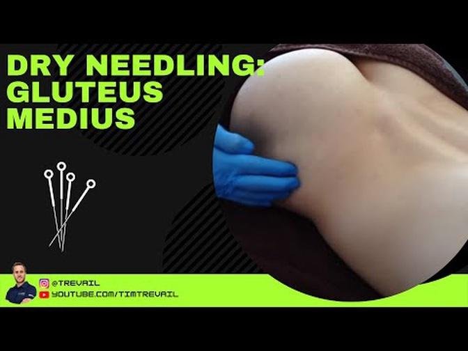 Dry Needling: Gluteus Medius