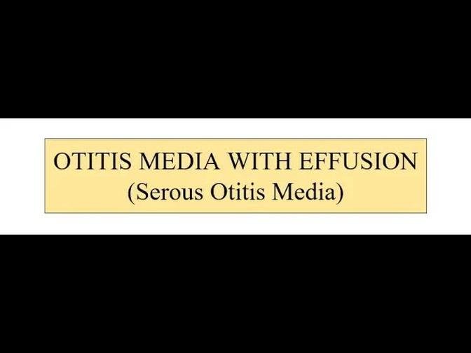 OTITIS MEDIA WITH EFFUSION