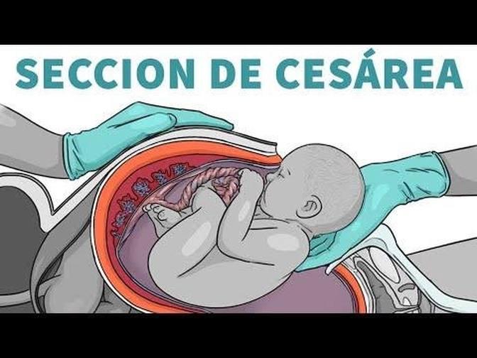 Parto por Cesárea: 13 Preguntas Frequentes Sobre la Cesárea | Stanford