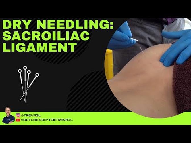 Dry Needling: Sacroiliac Ligament