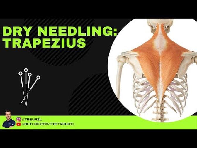 Dry Needling: Trapezius