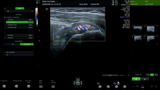 Ultrasound: Supraspinatus muscle tedon: inflammation