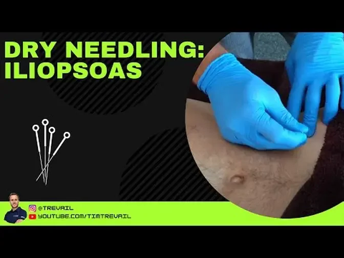 Dry Needling: Iliopsoas