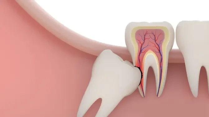 Recovery Roadmap: Navigating the Healing Process After Wisdom Tooth Extraction