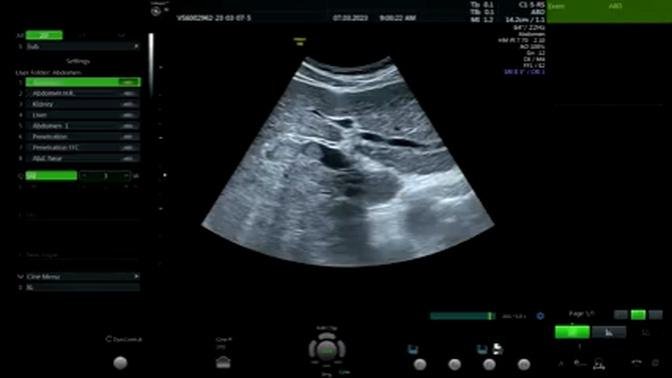 HCC Portal Vein Thrombosis Ultrasound