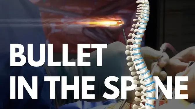 BULLET in the SPINE - Operation video