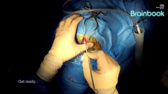 External Ventricular Drain insertion