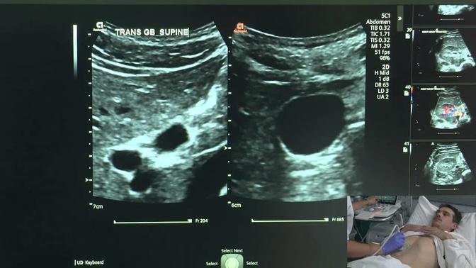 Ultrasound of the Gallbladder