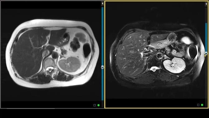 T2 Turbo Spin Echo Sequence on MRI - Liver Protocols | Videos | MRI ...