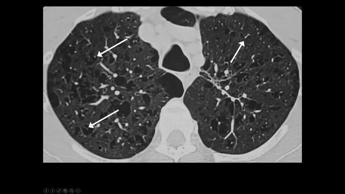 CT Patterns of Lung Disease, Dr. Jannette Collins - MRI Online Noon ...