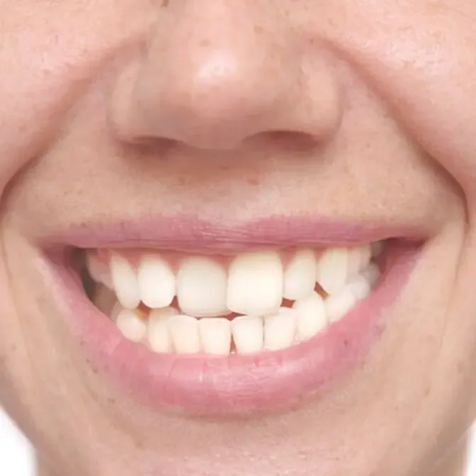 Beyond Aesthetics: The Health Benefits of Correcting Crowded Teeth