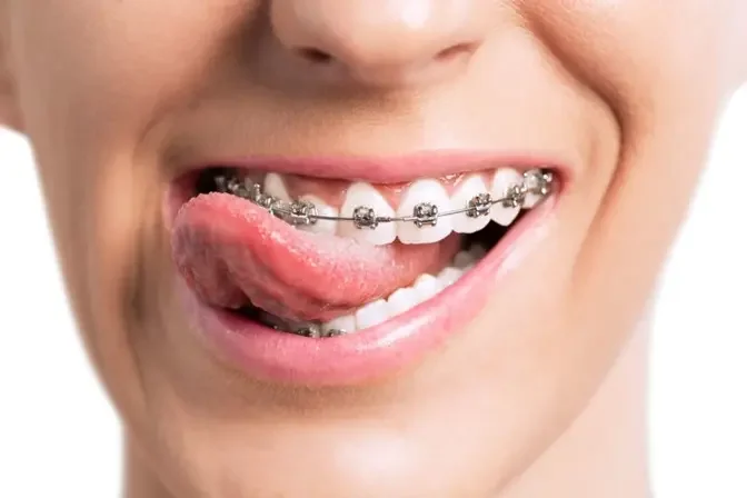 Perfecting Smiles: Navigating the World of Orthodontics in Dubai