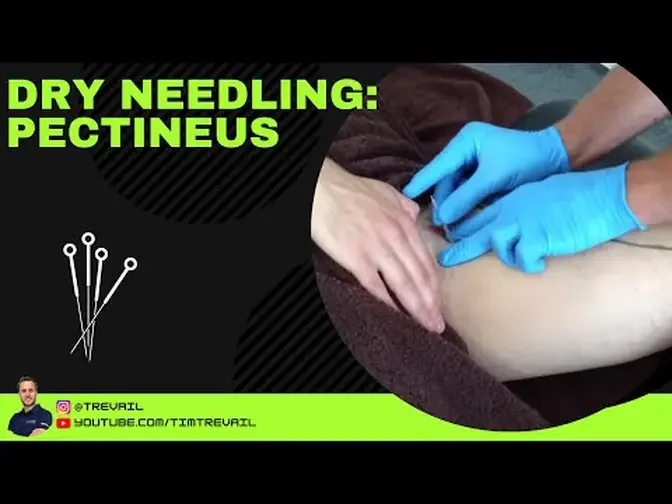 Dry Needling: Pectineus
